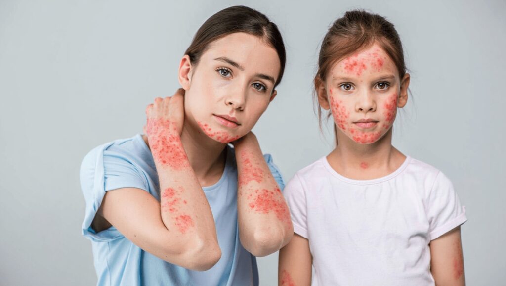 Évolution de la dermatite atopique : ce qui change de l’enfance à l’âge adulte